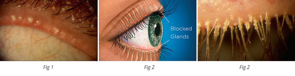 Dry Eye Graphic