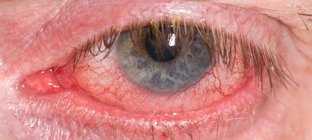 Minor Eye Conditions Service