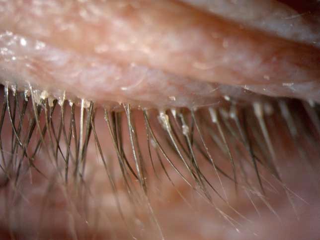 Demodex Eyelashes