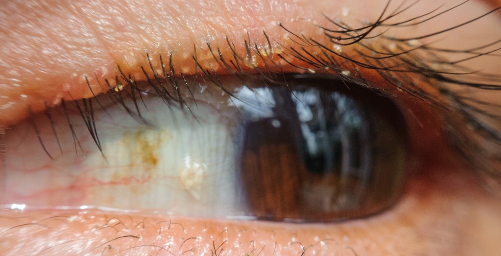 Blepharitis