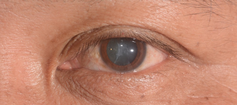 Information about cataracts