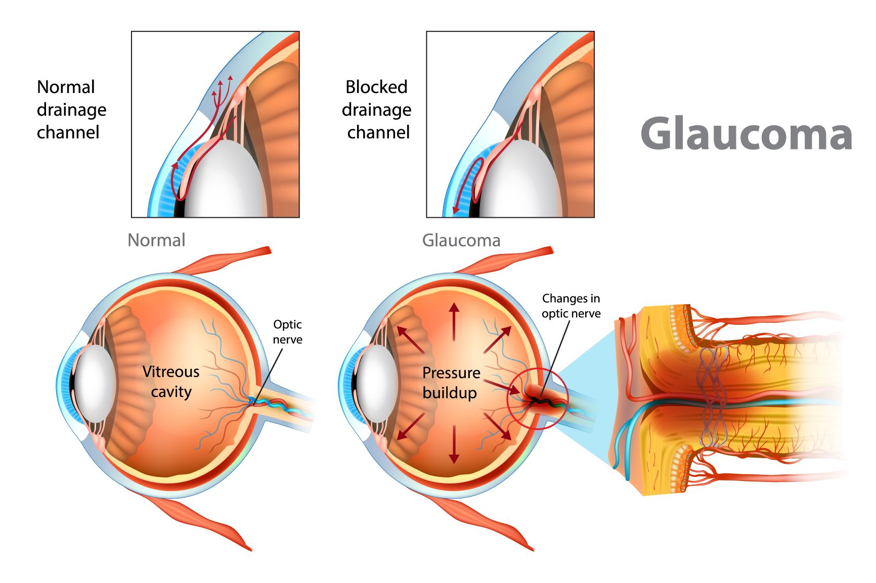 Information about Glaucoma