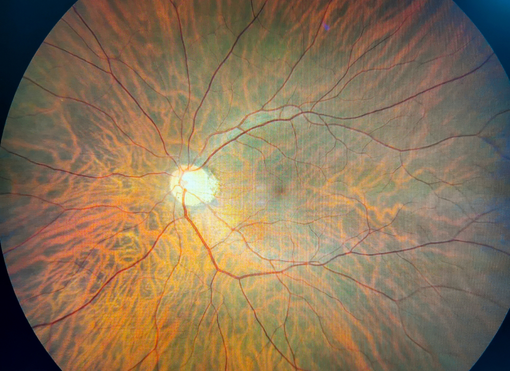 What is a Posterior Vitreous Detachment?