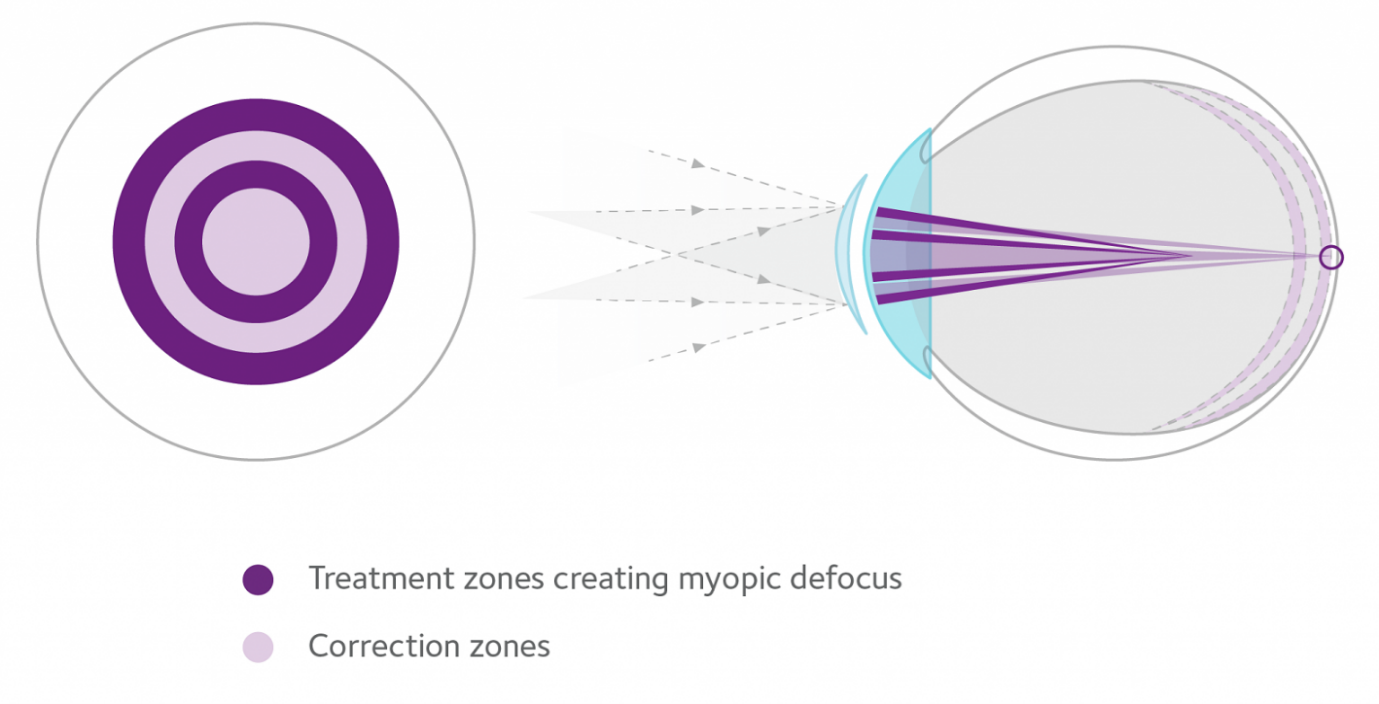 Myopia Management